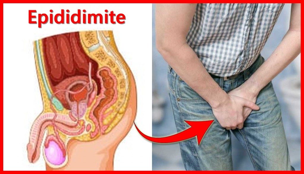 Epididimite